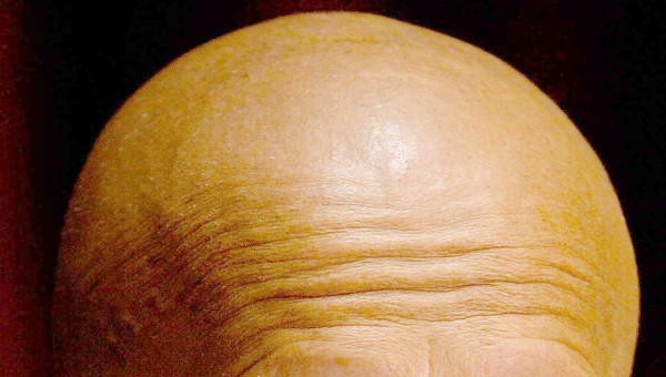 Baldness