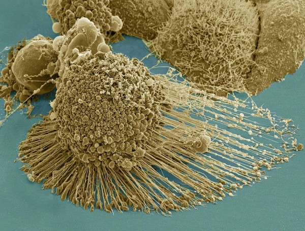 A cancer cell with stringy “legs” called called filopodia, extending to the right.